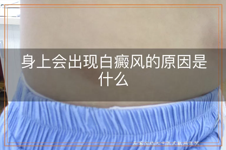 身上会出现白癜风的原因是什么