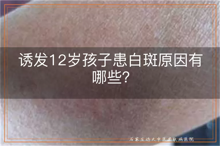 诱发12岁孩子患白斑原因有哪些？