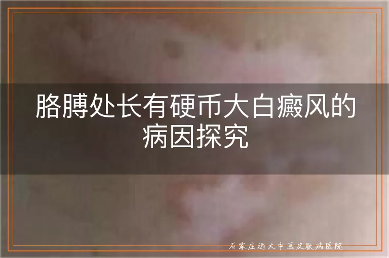 胳膊处长有硬币大白癜风的病因探究