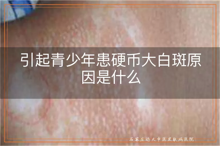 引起青少年患硬币大白斑原因是什么