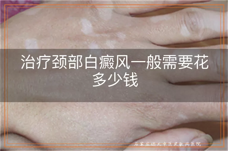 治疗颈部白癜风一般需要花多少钱