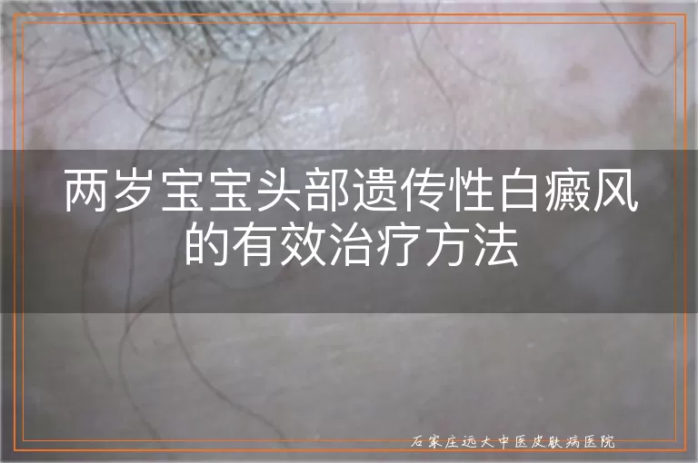 两岁宝宝头部遗传性白癜风的有效治疗方法