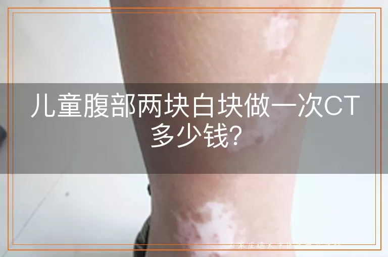 儿童腹部两块白块做一次CT多少钱？
