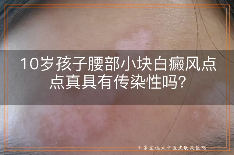 10岁孩子腰部小块白癜风点点真具有传染性吗？