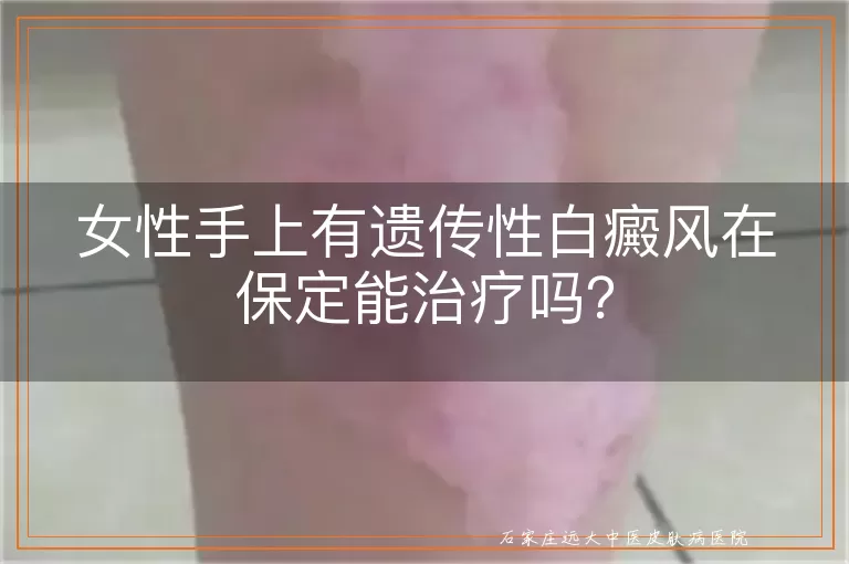 女性手上有遗传性白癜风在保定能治疗吗？