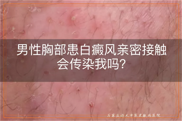 男性胸部患白癜风亲密接触会传染我吗？
