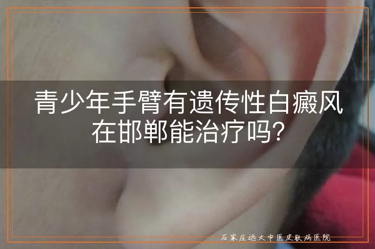 青少年手臂有遗传性白癜风在邯郸能治疗吗？