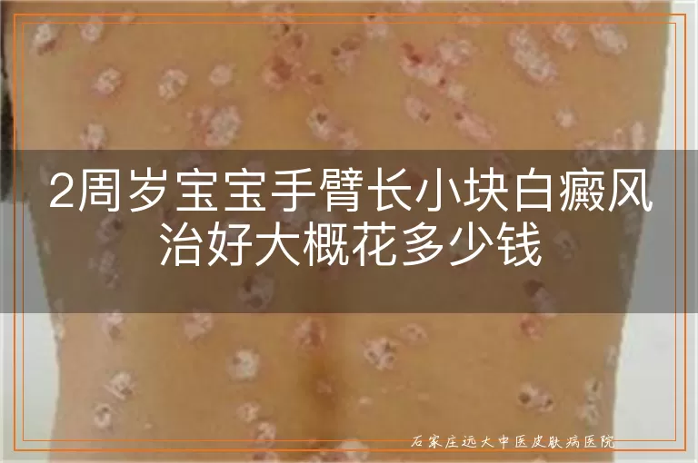 2周岁宝宝手臂长小块白癜风治好大概花多少钱