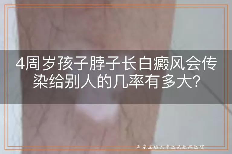 4周岁孩子脖子长白癜风会传染给别人的几率有多大？