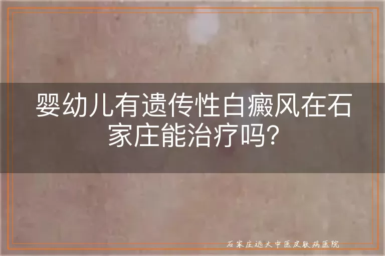 婴幼儿有遗传性白癜风在石家庄能治疗吗？