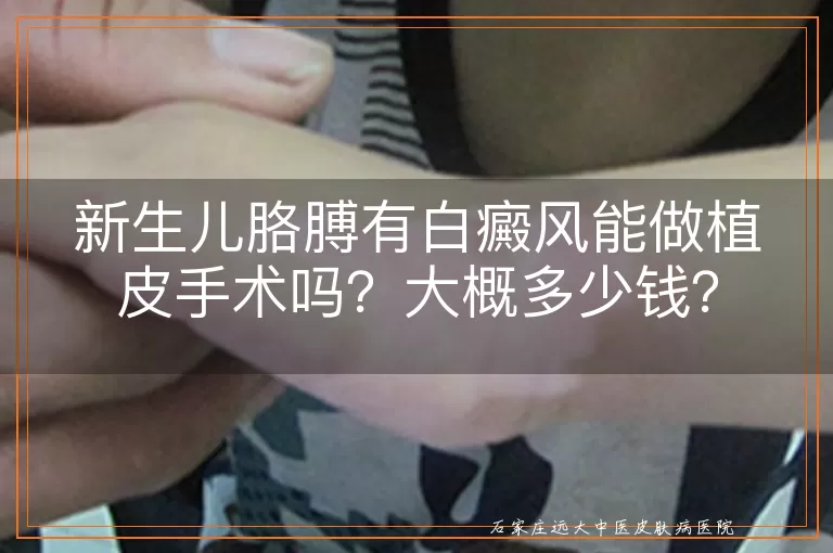 新生儿胳膊有白癜风能做植皮手术吗？大概多少钱？