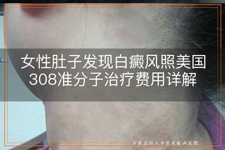 女性肚子发现白癜风照美国308准分子治疗费用详解