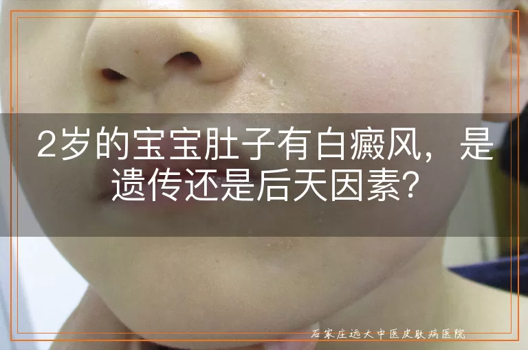 2岁的宝宝肚子有白癜风，是遗传还是后天因素？