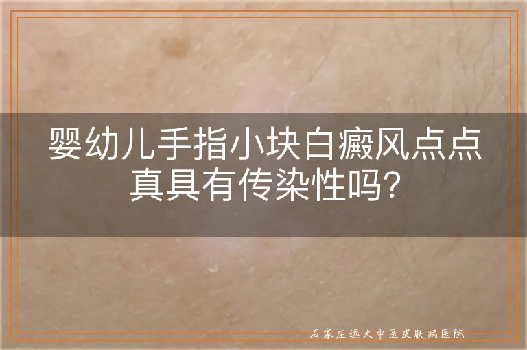 婴幼儿手指小块白癜风点点真具有传染性吗？