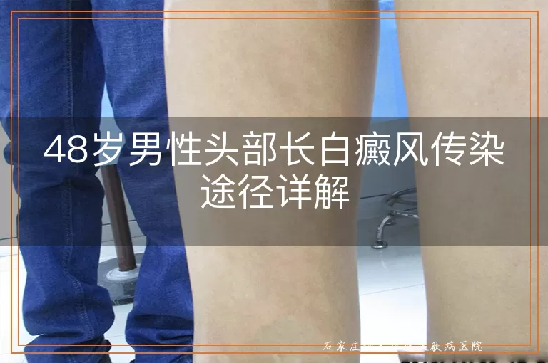48岁男性头部长白癜风传染途径详解