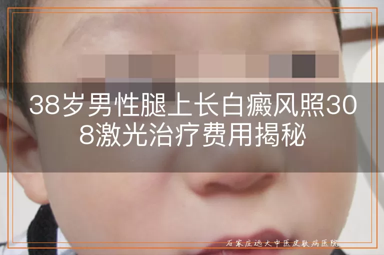 38岁男性腿上长白癜风照308激光治疗费用揭秘
