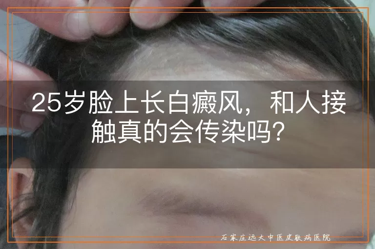 25岁脸上长白癜风，和人接触真的会传染吗？