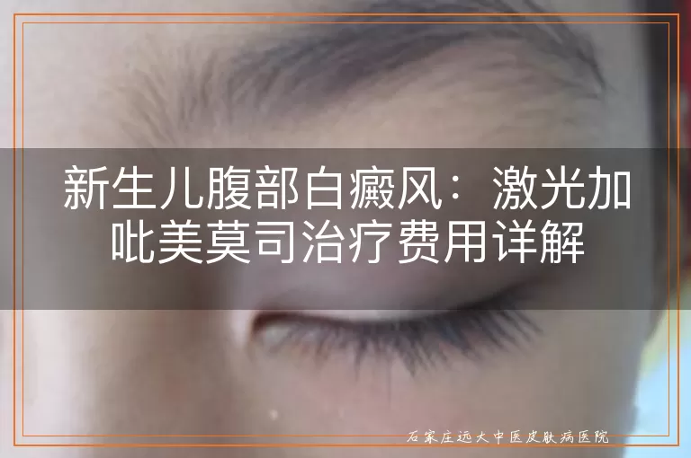 新生儿腹部白癜风：激光加吡美莫司治疗费用详解