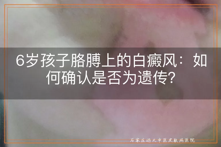 6岁孩子胳膊上的白癜风：如何确认是否为遗传？
