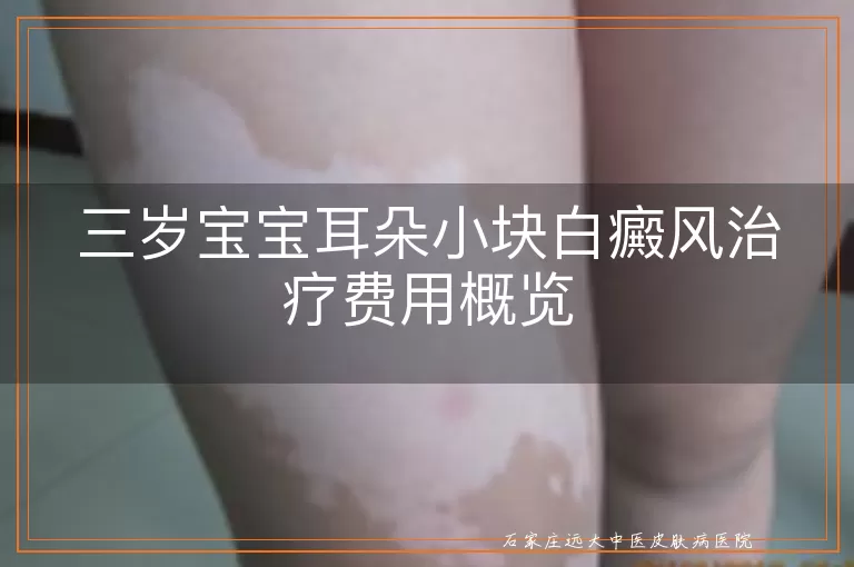三岁宝宝耳朵小块白癜风治疗费用概览