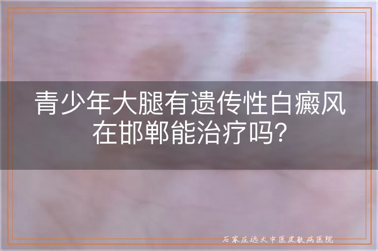 青少年大腿有遗传性白癜风在邯郸能治疗吗？