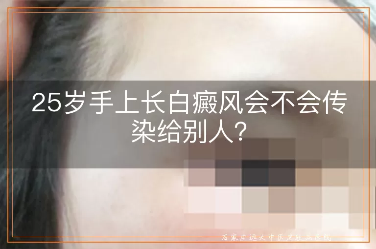 25岁手上长白癜风会不会传染给别人？
