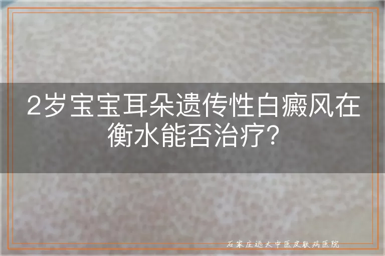 2岁宝宝耳朵遗传性白癜风在衡水能否治疗？