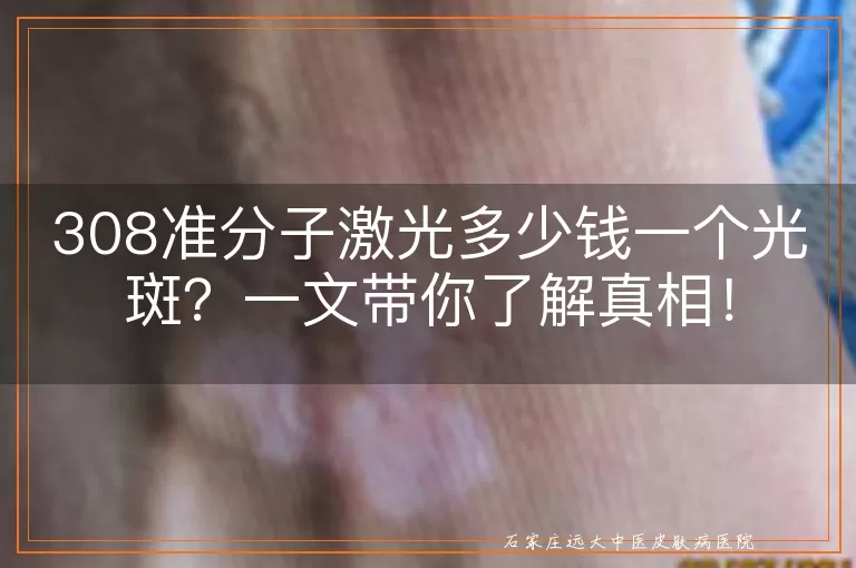 308准分子激光多少钱一个光斑？一文带你了解真相！