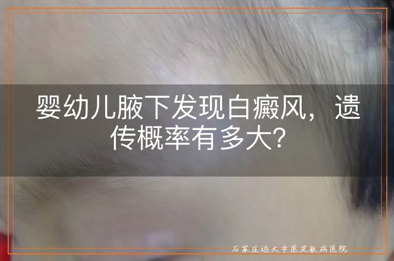 婴幼儿腋下发现白癜风，遗传概率有多大？