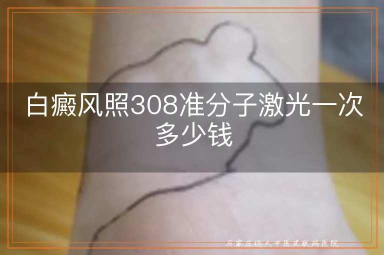白癜风照308准分子激光一次多少钱