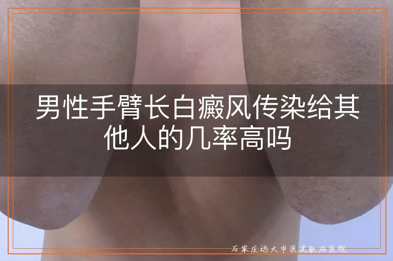 男性手臂长白癜风传染给其他人的几率高吗