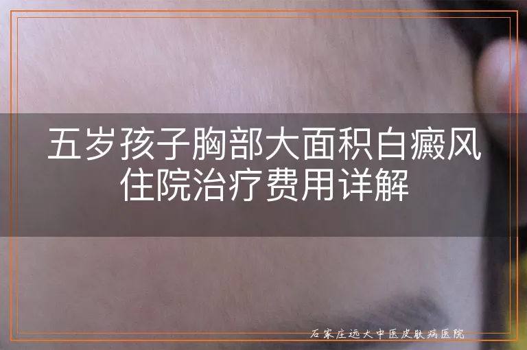 五岁孩子胸部大面积白癜风住院治疗费用详解