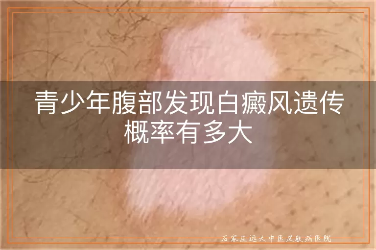 青少年腹部发现白癜风遗传概率有多大