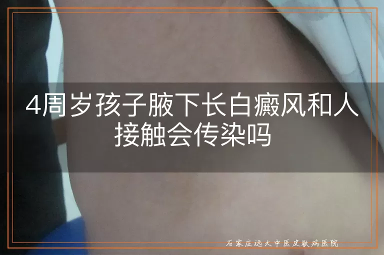 4周岁孩子腋下长白癜风和人接触会传染吗
