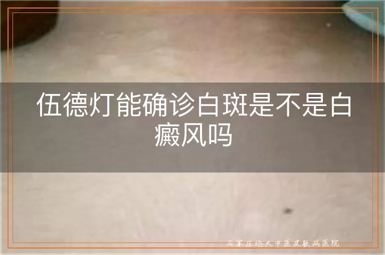 伍德灯能确诊白斑是不是白癜风吗
