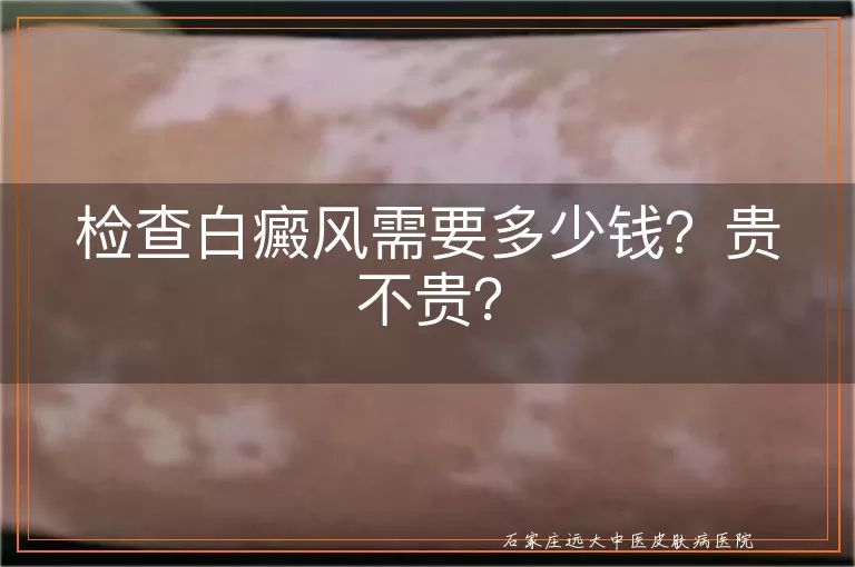 检查白癜风需要多少钱？贵不贵？