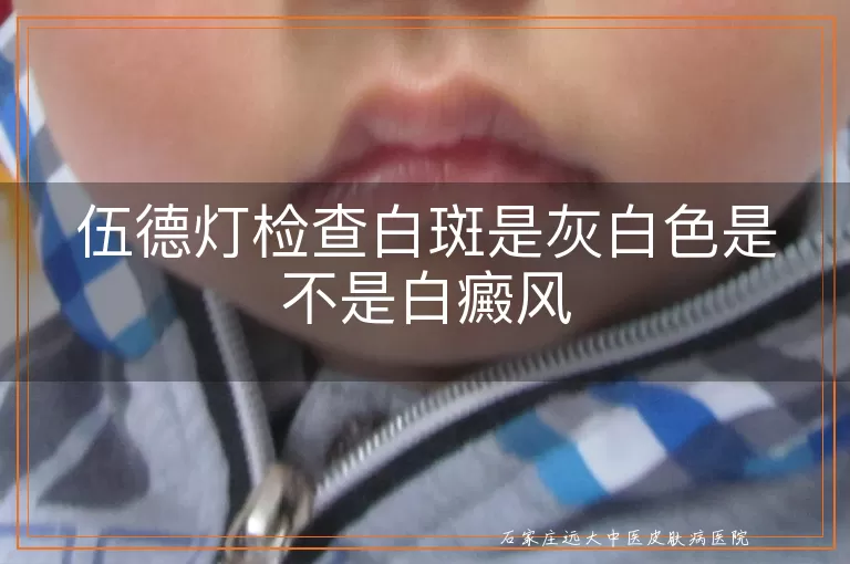 伍德灯检查白斑是灰白色是不是白癜风