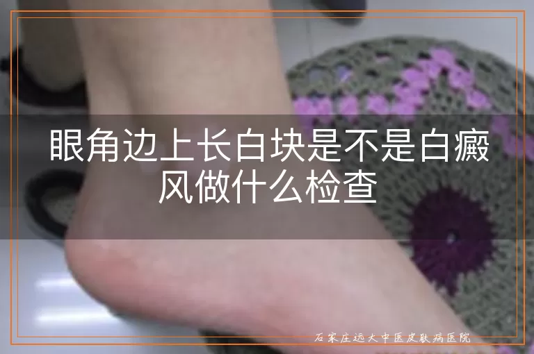 眼角边上长白块是不是白癜风做什么检查