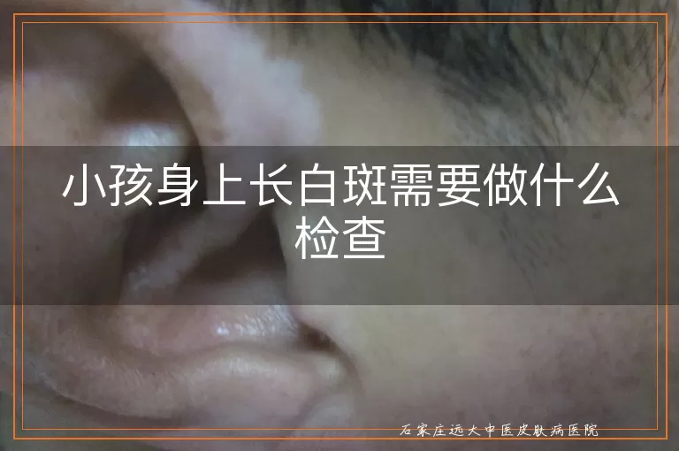 小孩身上长白斑需要做什么检查
