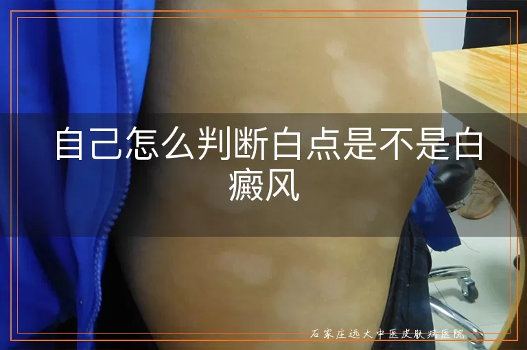 自己怎么判断白点是不是白癜风