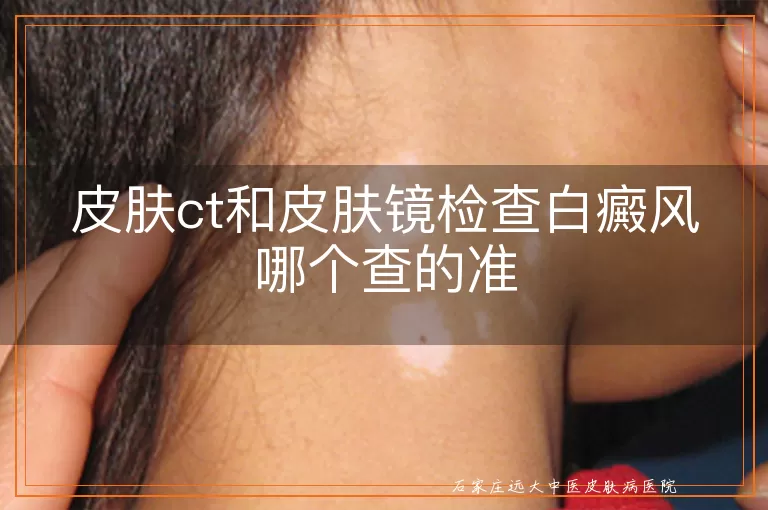 皮肤ct和皮肤镜检查白癜风哪个查的准