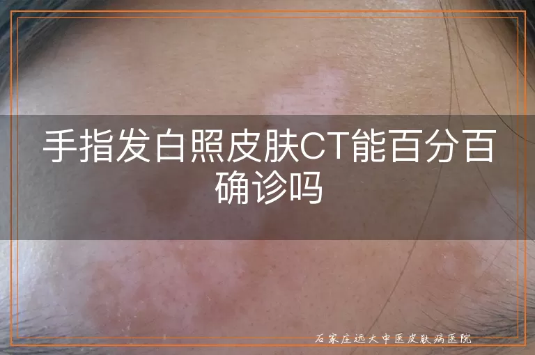 手指发白照皮肤CT能百分百确诊吗