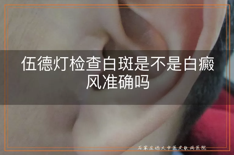 伍德灯检查白斑是不是白癜风准确吗