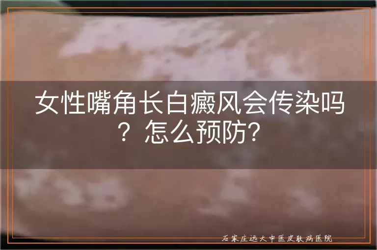 女性嘴角长白癜风会传染吗？怎么预防？