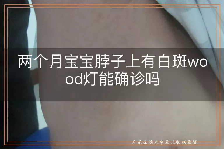 两个月宝宝脖子上有白斑wood灯能确诊吗