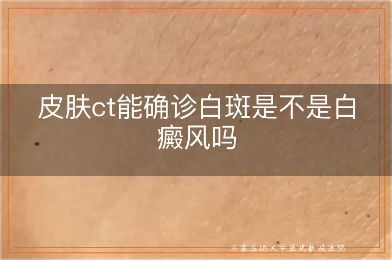 皮肤ct能确诊白斑是不是白癜风吗