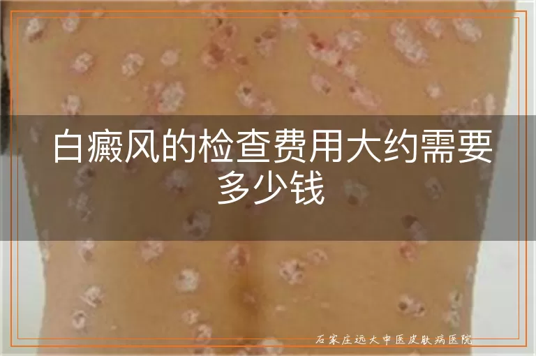 白癜风的检查费用大约需要多少钱
