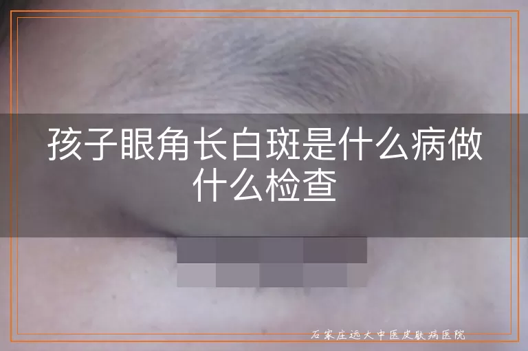孩子眼角长白斑是什么病做什么检查