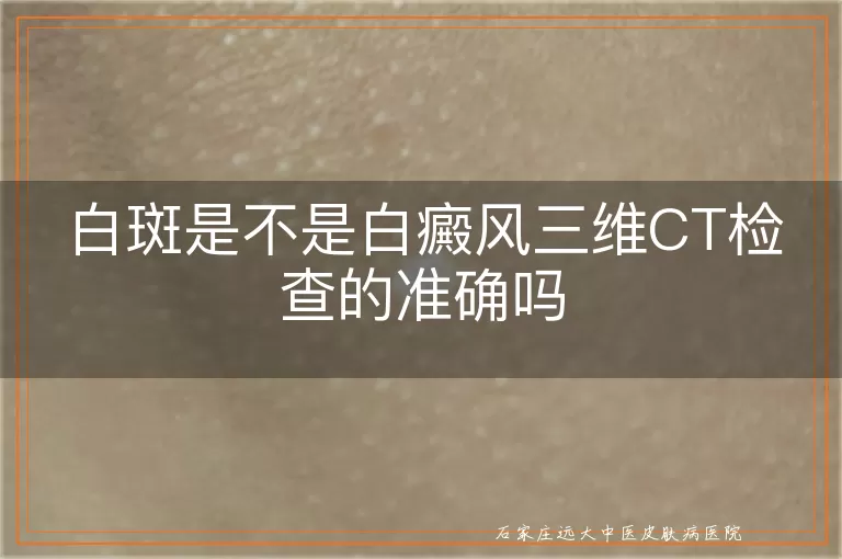 白斑是不是白癜风三维CT检查的准确吗