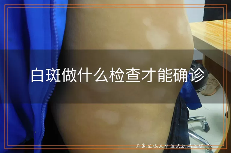 白斑做什么检查才能确诊